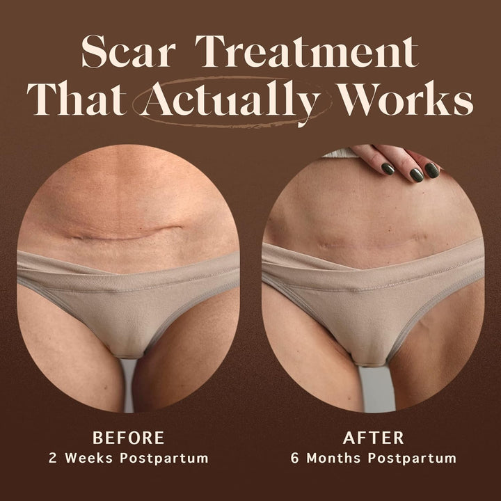 - Restorative Scar Treatment for C Section Recovery - C Section Scar Treatment for Postpartum - Reduces the Appearance of Scars from Acne - Vegan & Cruelty-Free - 1 Oz.